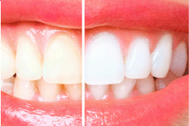 Teeth Whitening & Opalescence at E Dental